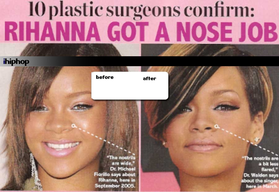 Rihanna Had A Nose Job!!!Pics Of Her New Nose Inside!!!